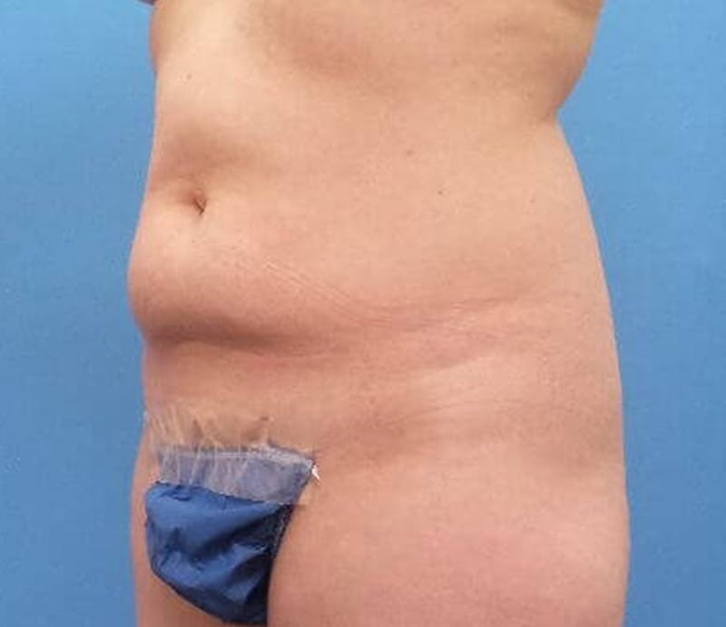 Abdominoplasty Before & After Gallery - Patient 239575 - Image 3