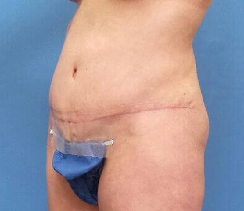 Abdominoplasty Before & After Gallery - Patient 428959 - Image 4