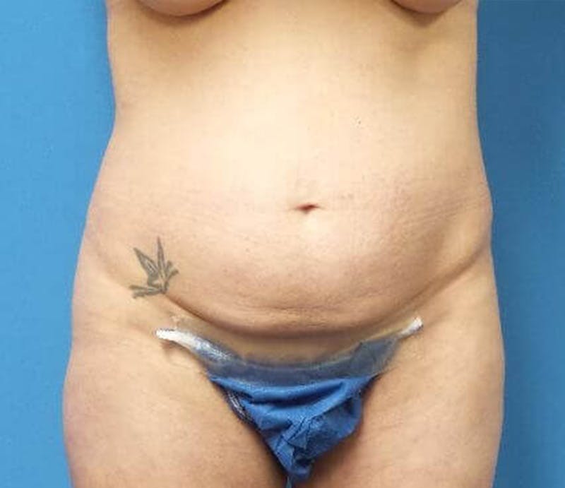 Abdominoplasty Before & After Gallery - Patient 428959 - Image 1