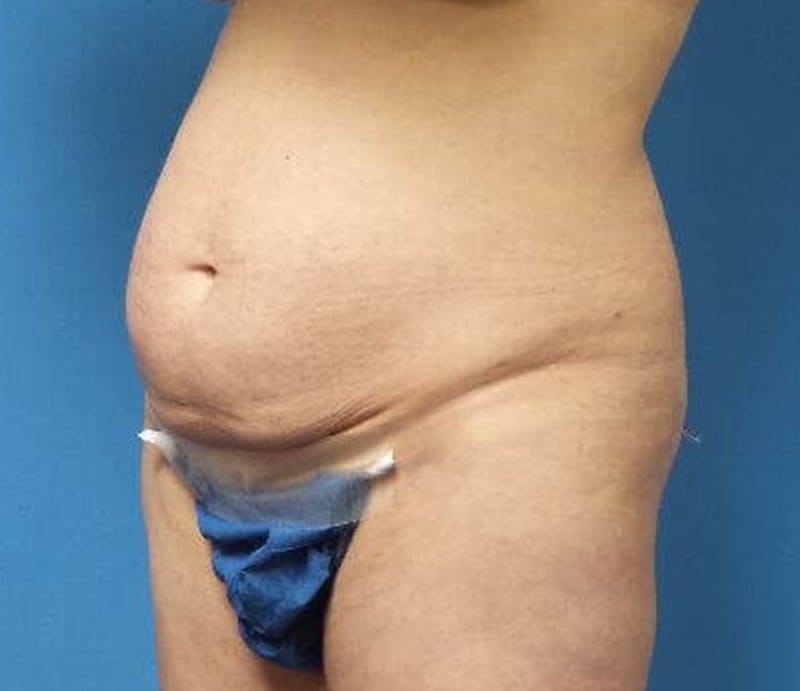 Abdominoplasty Before & After Gallery - Patient 428959 - Image 3