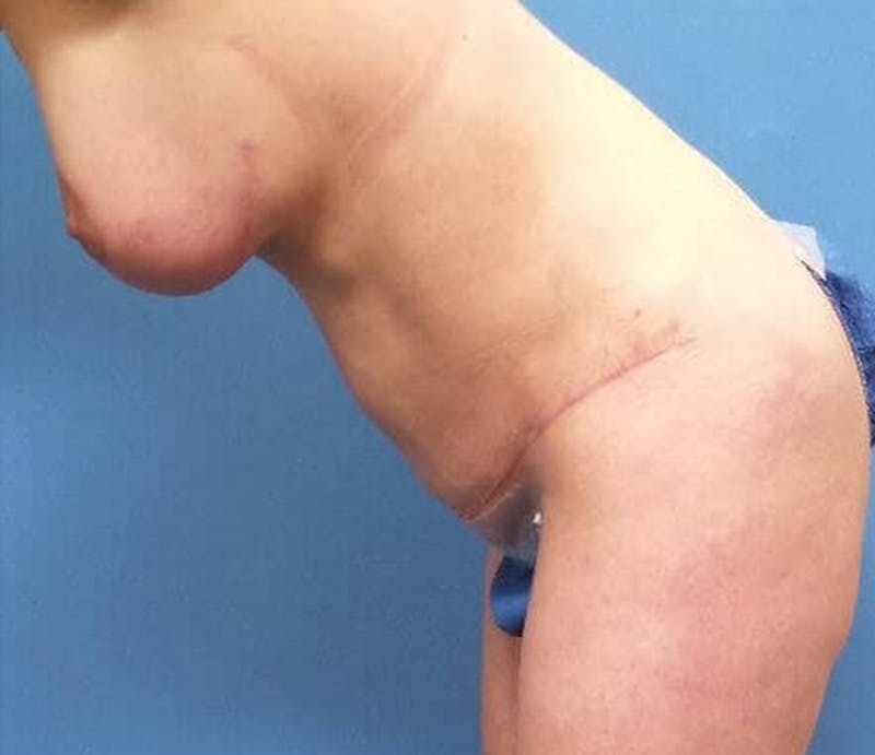 Abdominoplasty Before & After Gallery - Patient 428959 - Image 6