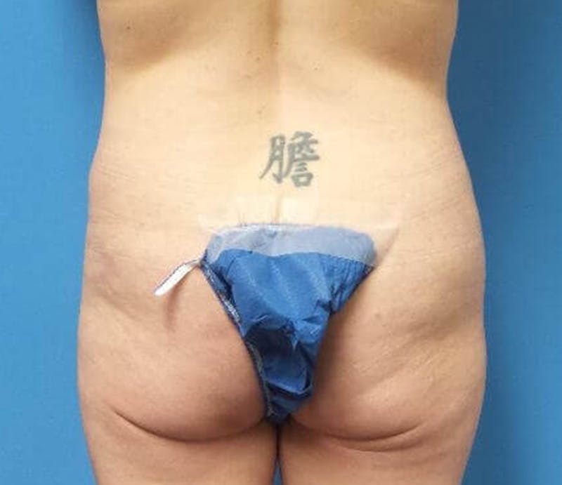Abdominoplasty Before & After Gallery - Patient 428959 - Image 7