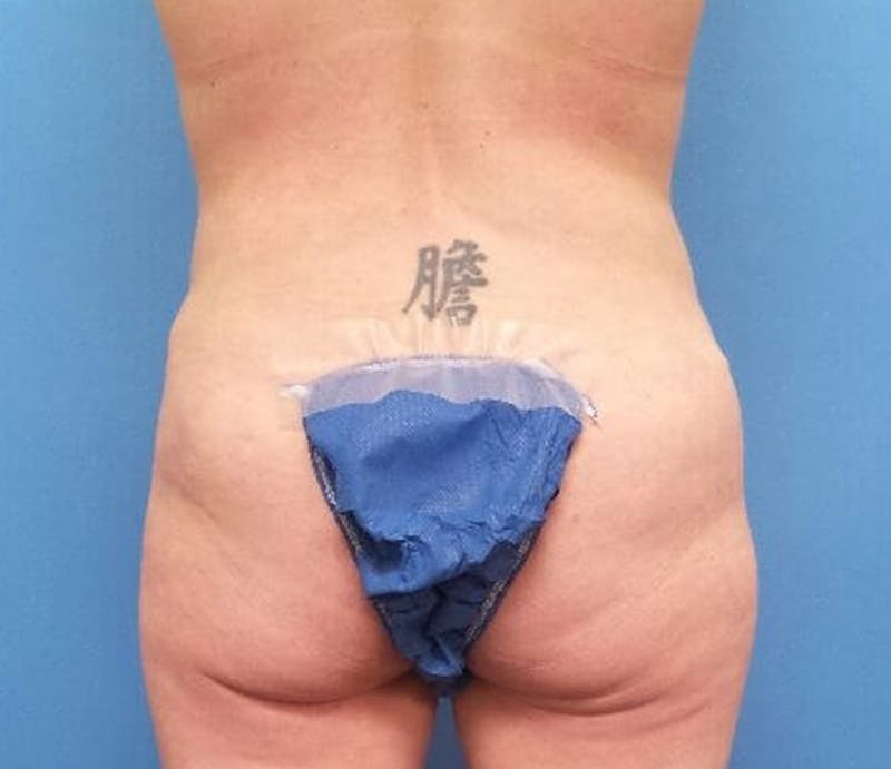 Abdominoplasty Before & After Gallery - Patient 428959 - Image 8
