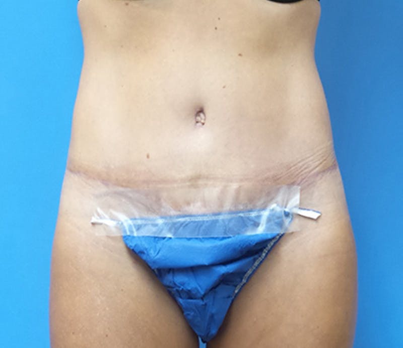 Abdominoplasty Before & After Gallery - Patient 349782 - Image 2