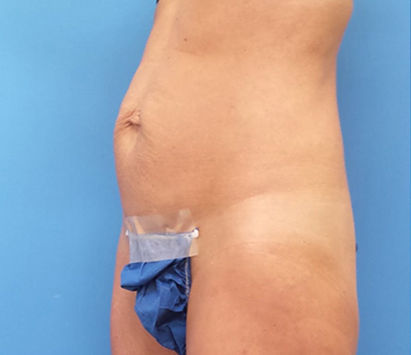 Abdominoplasty Before & After Gallery - Patient 349782 - Image 3