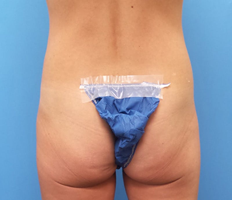 Abdominoplasty Before & After Gallery - Patient 349782 - Image 7