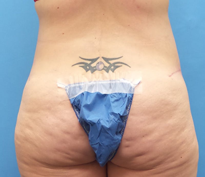Abdominoplasty Before & After Gallery - Patient 356862 - Image 8