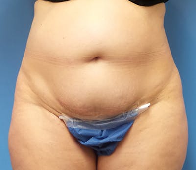 Abdominoplasty Before & After Gallery - Patient 356862 - Image 1