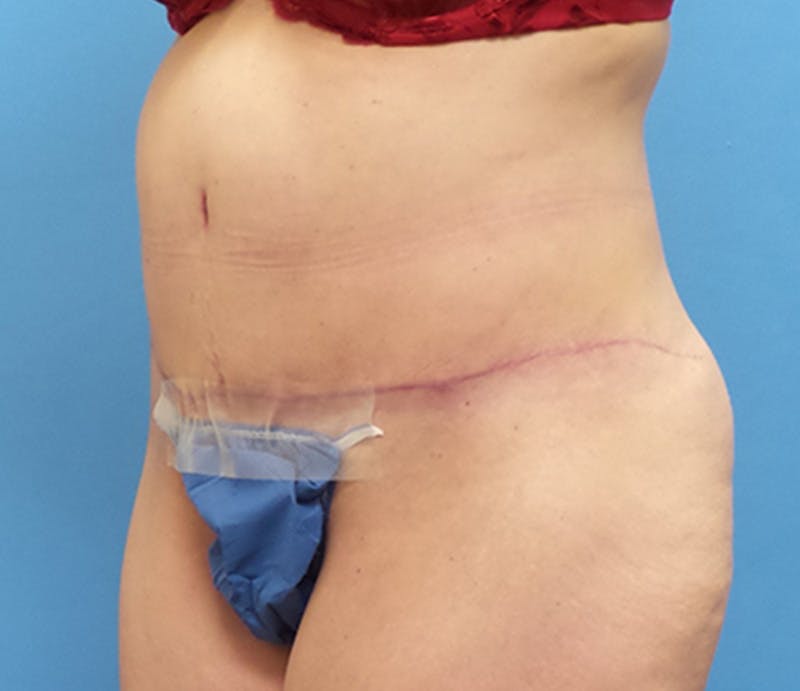 Abdominoplasty Before & After Gallery - Patient 356862 - Image 4