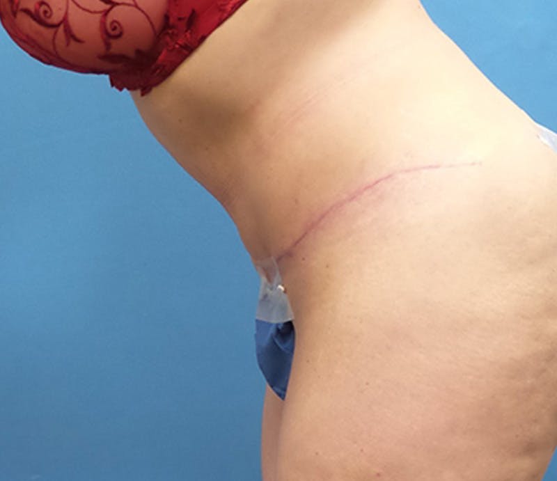Abdominoplasty Before & After Gallery - Patient 356862 - Image 6