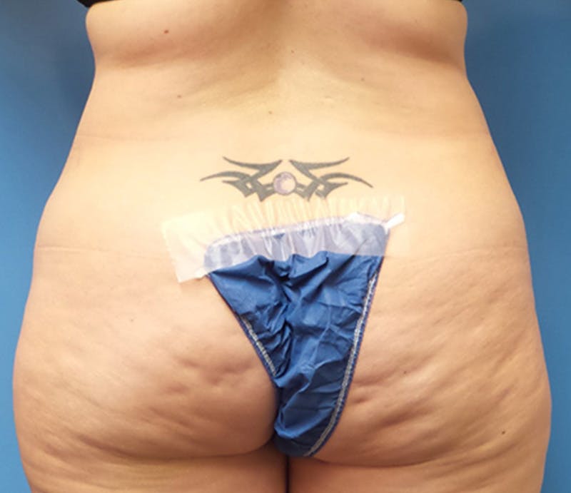 Abdominoplasty Before & After Gallery - Patient 356862 - Image 7
