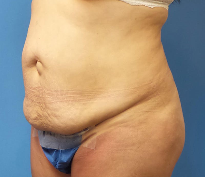 Abdominoplasty Before & After Gallery - Patient 276971 - Image 3