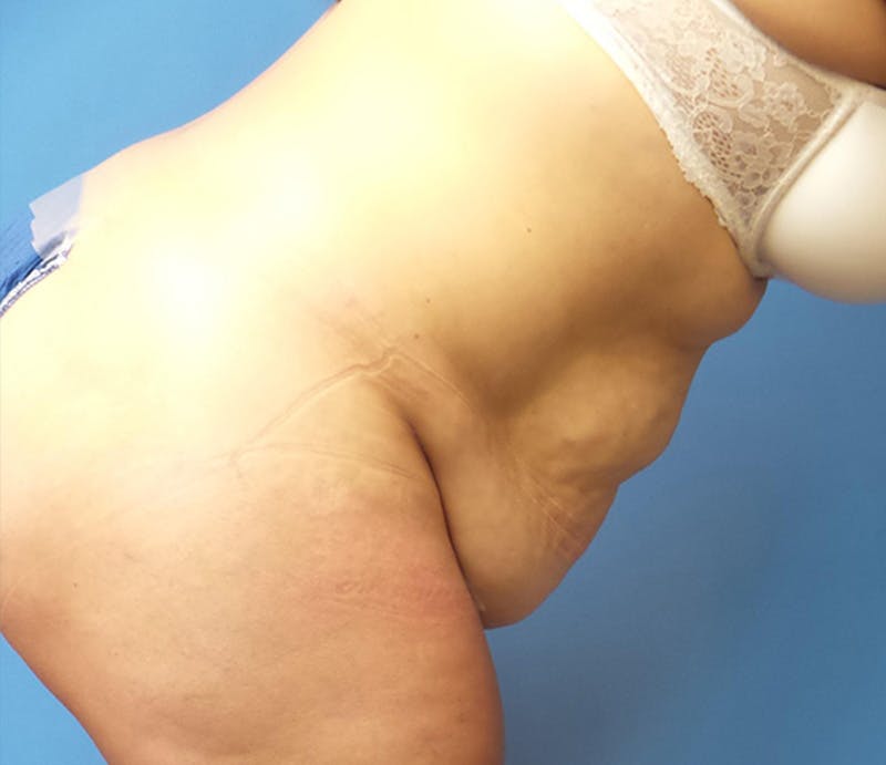 Abdominoplasty Before & After Gallery - Patient 276971 - Image 5