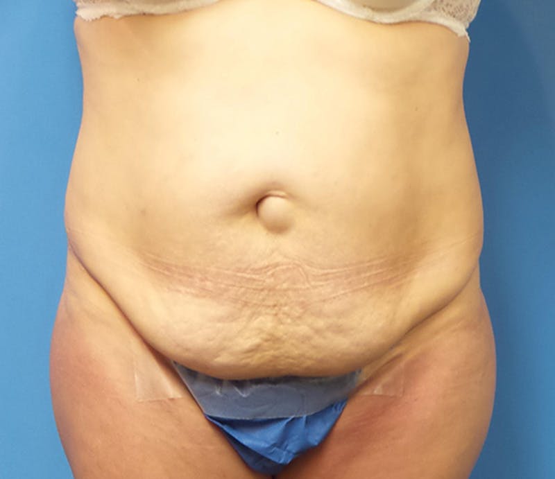 Abdominoplasty Before & After Gallery - Patient 276971 - Image 1
