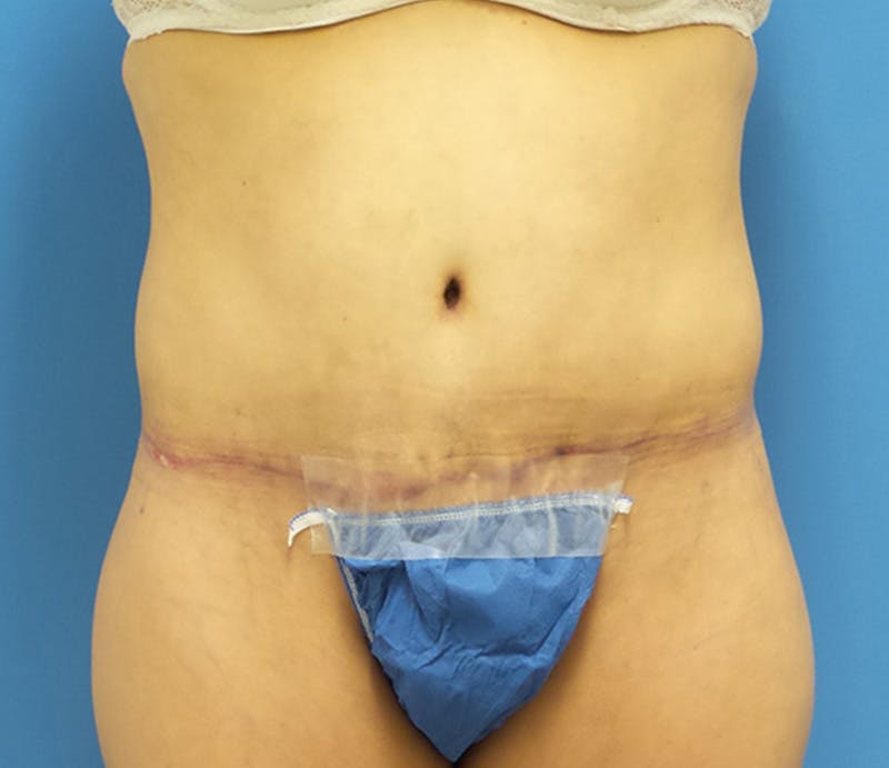 Abdominoplasty Before & After Gallery - Patient 276971 - Image 2