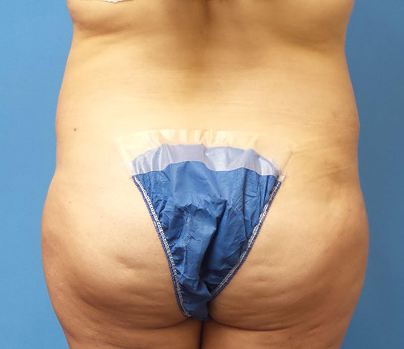 Abdominoplasty Before & After Gallery - Patient 276971 - Image 7
