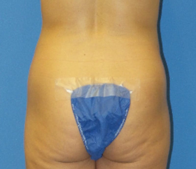 Abdominoplasty Before & After Gallery - Patient 157456 - Image 7