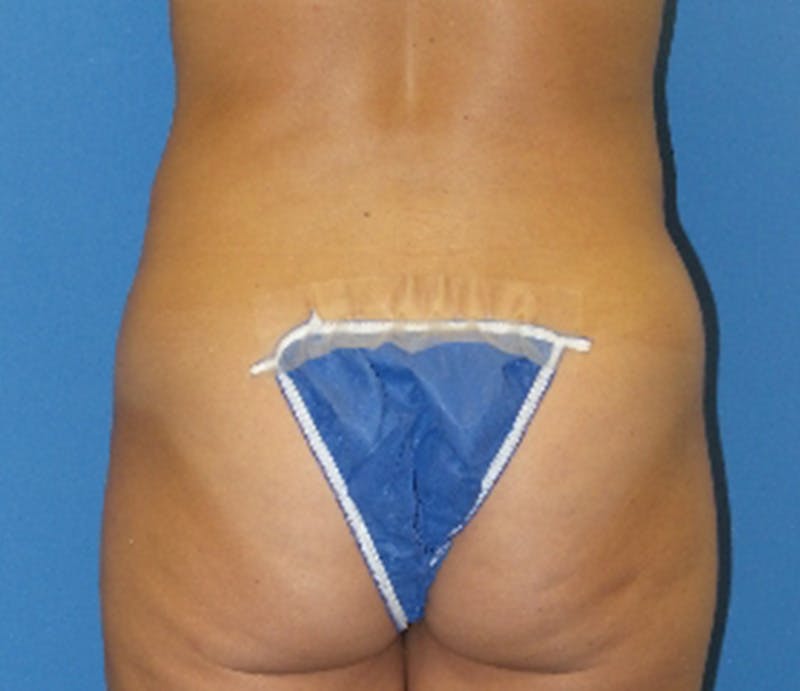 Abdominoplasty Before & After Gallery - Patient 157456 - Image 8