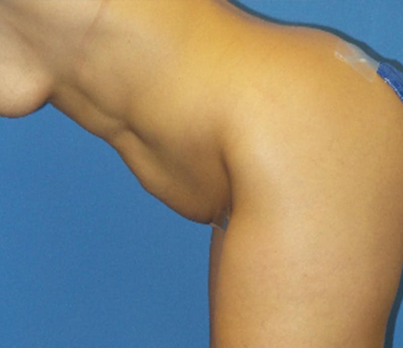 Abdominoplasty Before & After Gallery - Patient 157456 - Image 5
