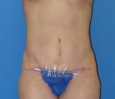 Abdominoplasty Before & After Gallery - Patient 322939 - Image 2