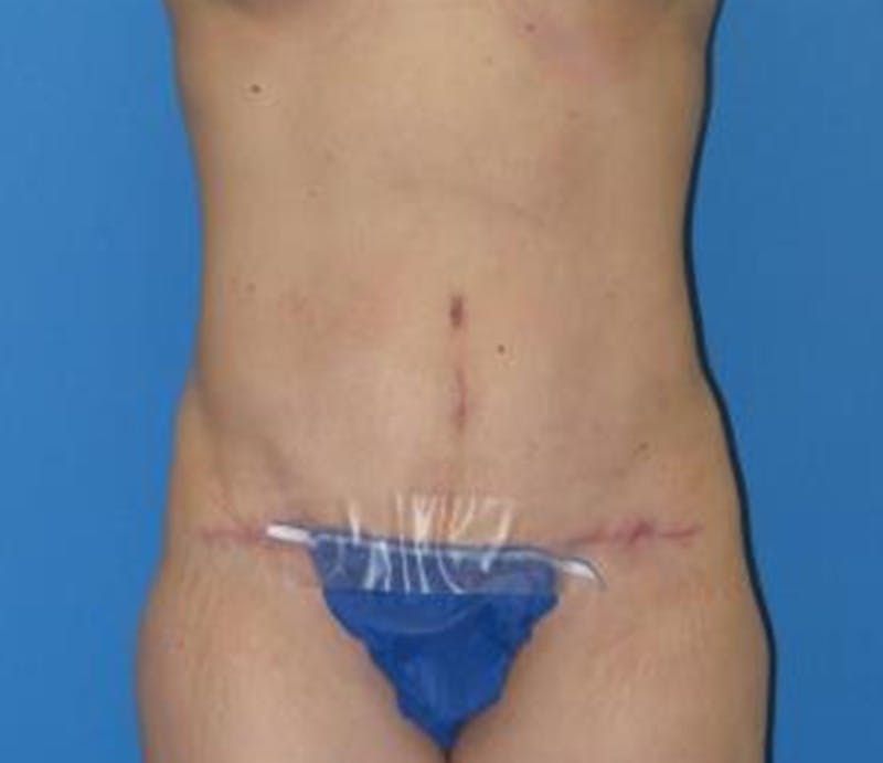 Abdominoplasty Before & After Gallery - Patient 322939 - Image 2