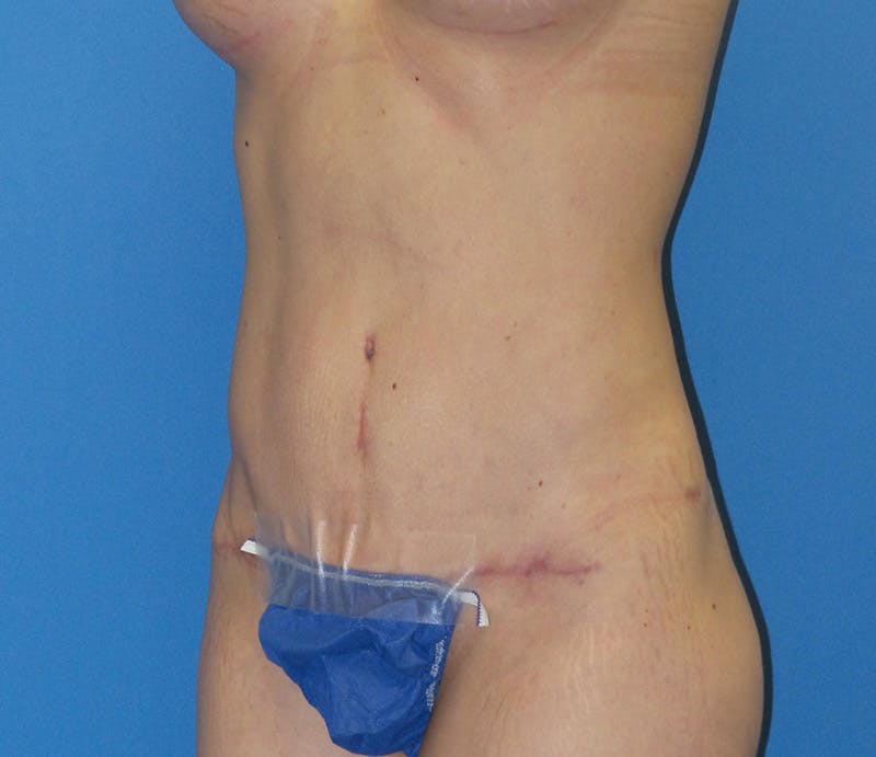 Abdominoplasty Before & After Gallery - Patient 322939 - Image 4