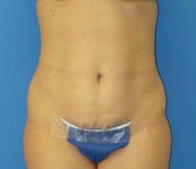 Abdominoplasty Before & After Gallery - Patient 322939 - Image 1