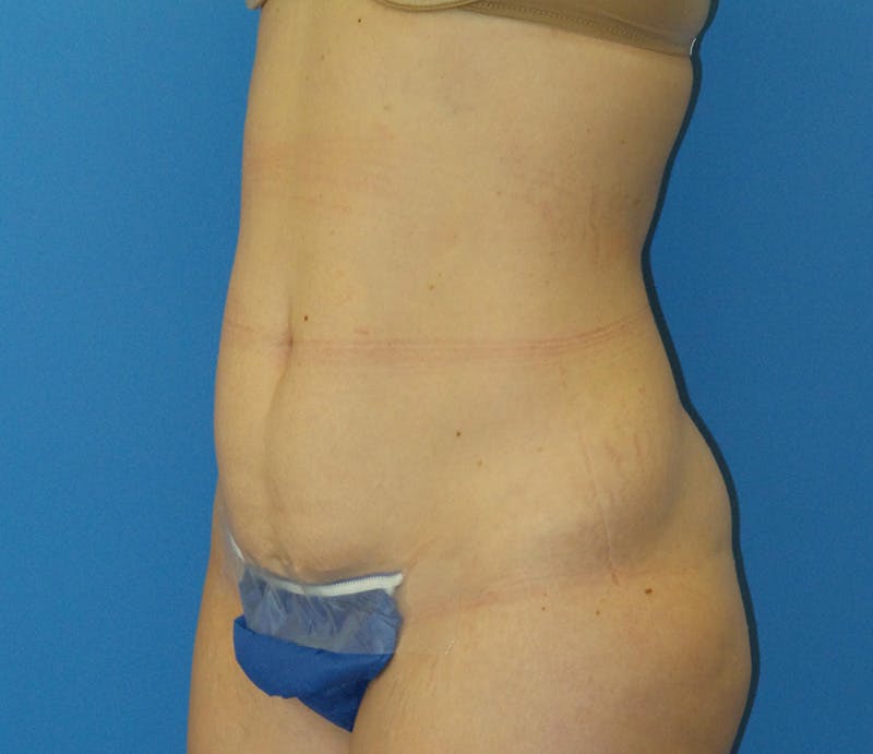 Abdominoplasty Before & After Gallery - Patient 322939 - Image 3