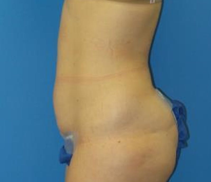 Abdominoplasty Before & After Gallery - Patient 322939 - Image 7