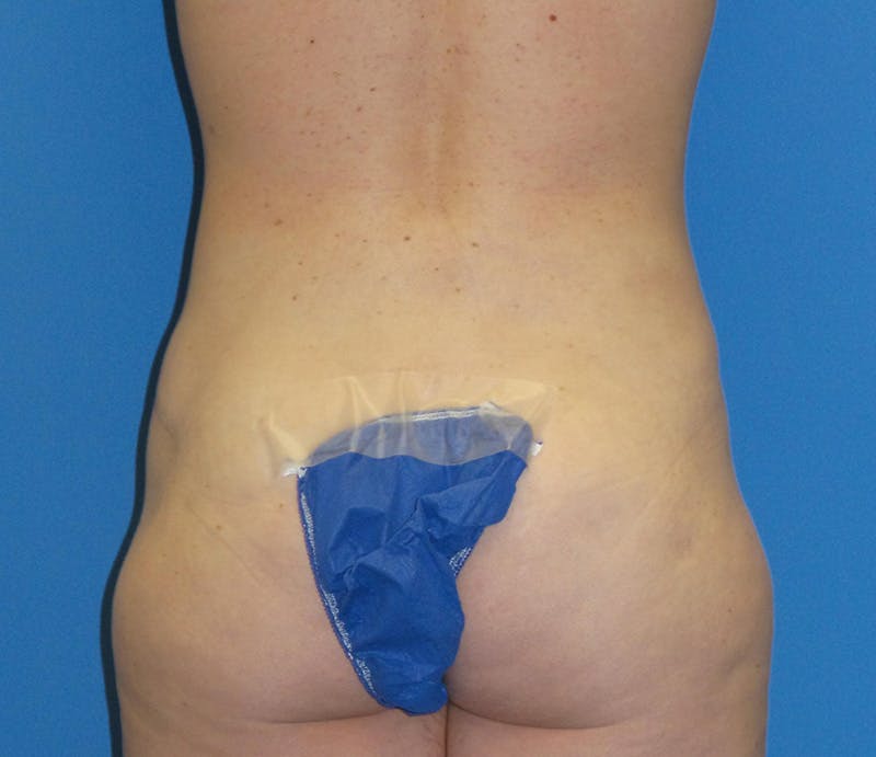 Abdominoplasty Before & After Gallery - Patient 322939 - Image 10