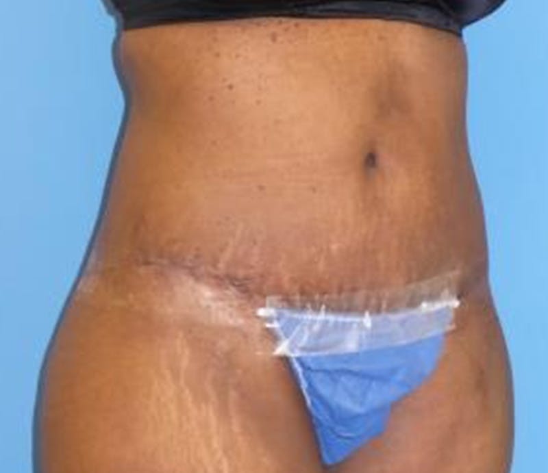 Abdominoplasty Before & After Gallery - Patient 211132 - Image 4