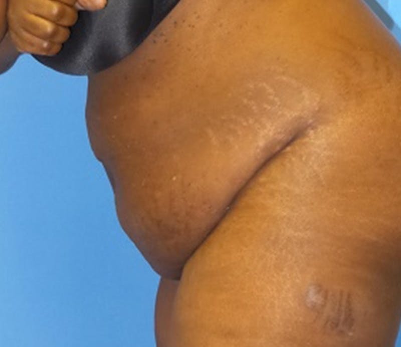 Abdominoplasty Before & After Gallery - Patient 211132 - Image 5