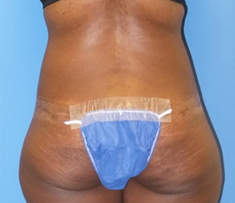 Abdominoplasty Before & After Gallery - Patient 211132 - Image 8