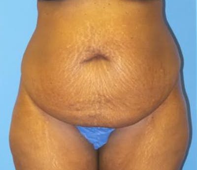 Abdominoplasty Before & After Gallery - Patient 211132 - Image 1