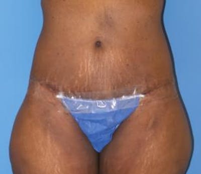 Abdominoplasty Before & After Gallery - Patient 211132 - Image 2