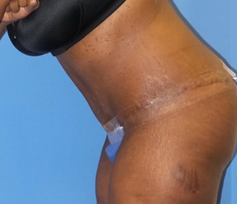 Abdominoplasty Before & After Gallery - Patient 211132 - Image 6
