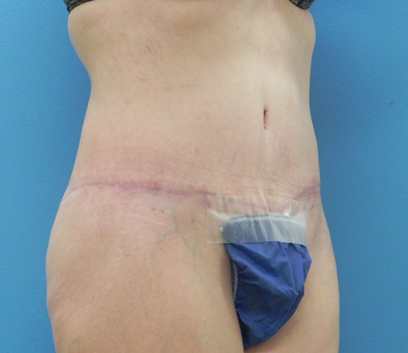 Abdominoplasty Before & After Gallery - Patient 898024 - Image 4