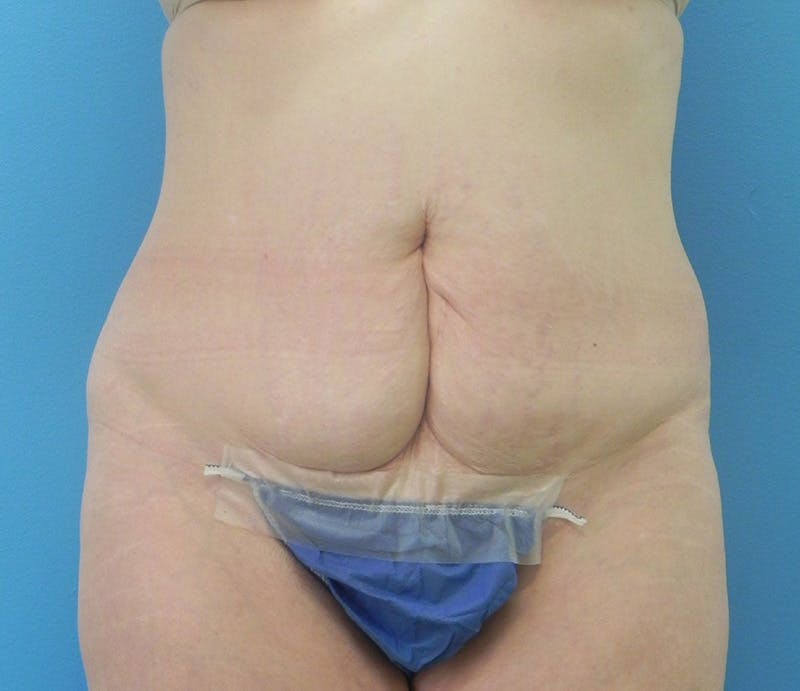 Abdominoplasty Before & After Gallery - Patient 898024 - Image 1
