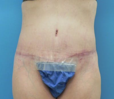Abdominoplasty Before & After Gallery - Patient 898024 - Image 2