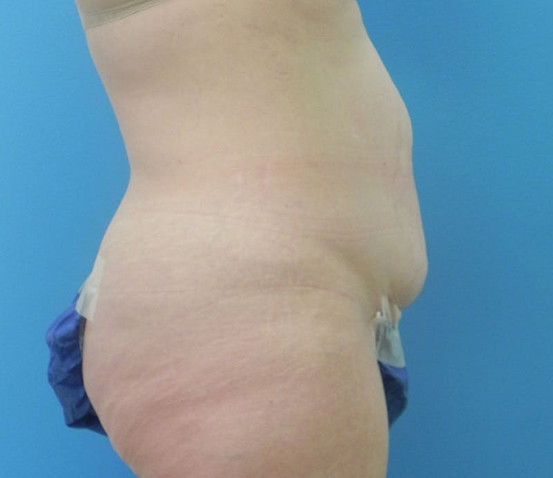 Abdominoplasty Before & After Gallery - Patient 898024 - Image 5