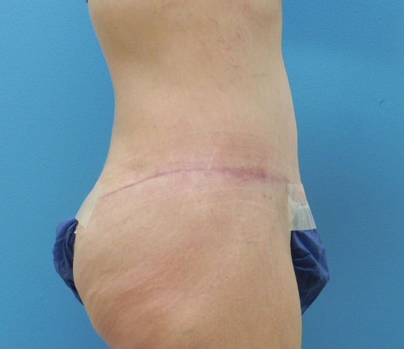 Abdominoplasty Before & After Gallery - Patient 898024 - Image 6