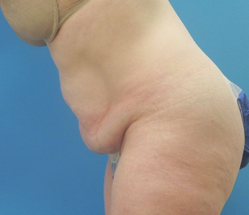 Abdominoplasty Before & After Gallery - Patient 898024 - Image 7