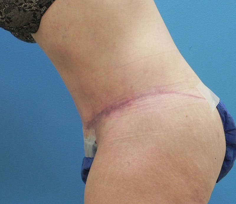 Abdominoplasty Before & After Gallery - Patient 898024 - Image 8