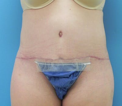 Abdominoplasty Before & After Gallery - Patient 358844 - Image 2