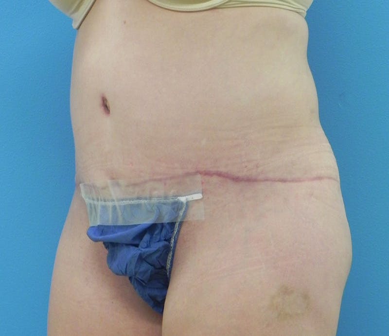 Abdominoplasty Before & After Gallery - Patient 358844 - Image 4