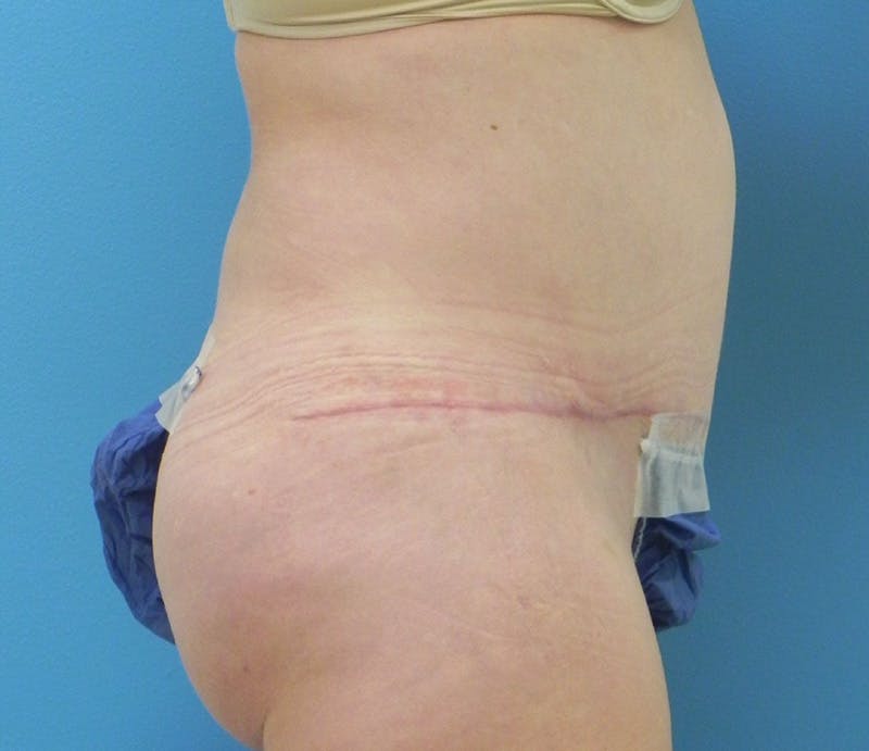 Abdominoplasty Before & After Gallery - Patient 358844 - Image 8