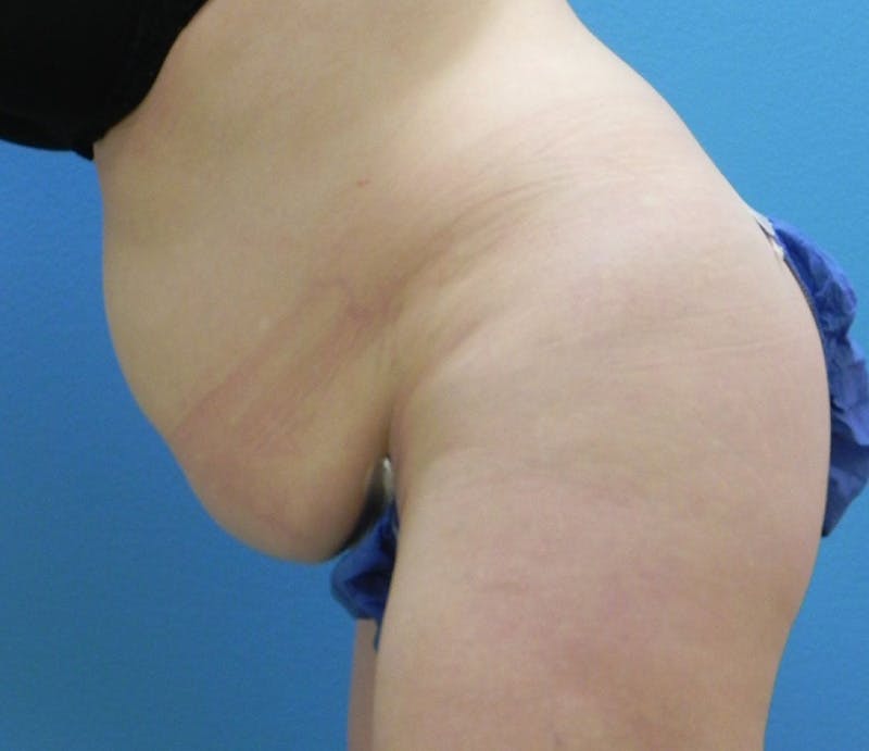 Abdominoplasty Before & After Gallery - Patient 358844 - Image 5