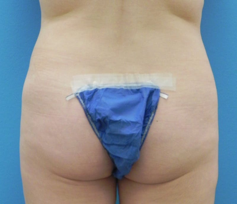 Abdominoplasty Before & After Gallery - Patient 358844 - Image 9