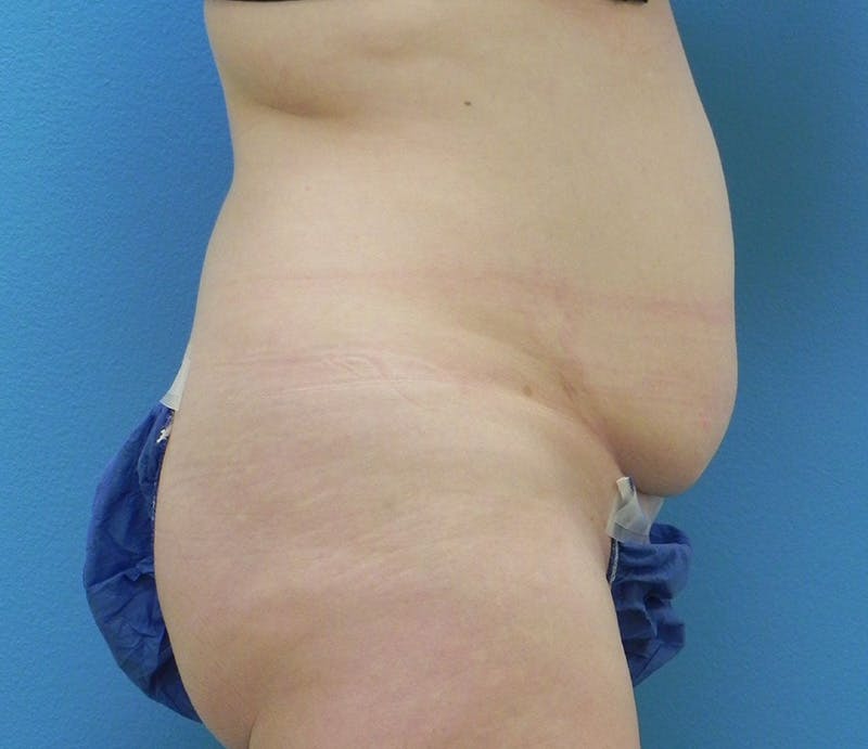Abdominoplasty Before & After Gallery - Patient 358844 - Image 7