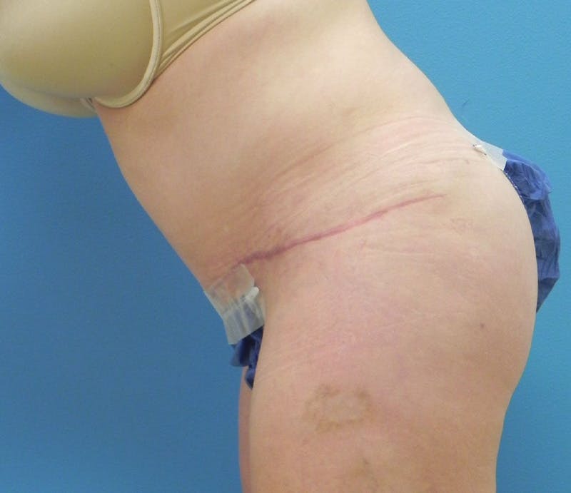 Abdominoplasty Before & After Gallery - Patient 358844 - Image 6